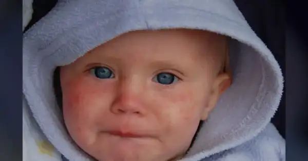 Oregon's 2026 Measles Cases Just Blew Past Last Year's Total