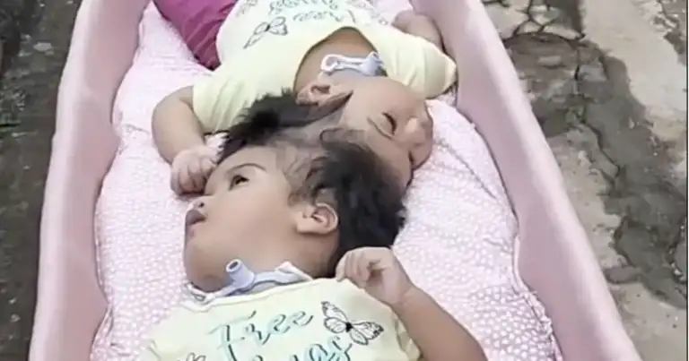 Two-year-old conjoined twins die after fifth risky separation surgery