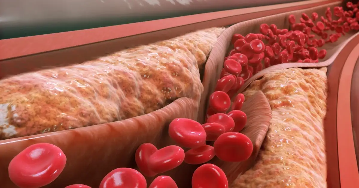 1 in 5 Have "Widow-Maker" Lp(a) Doubling Heart Attack Risk