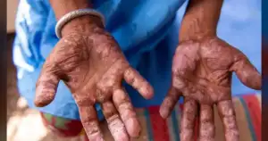Leprosy Surges in US Due to Climate Change and Travel Risks