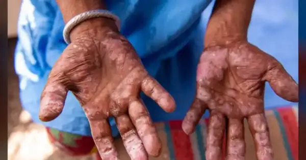 Leprosy Surges in US Due to Climate Change and Travel Risks