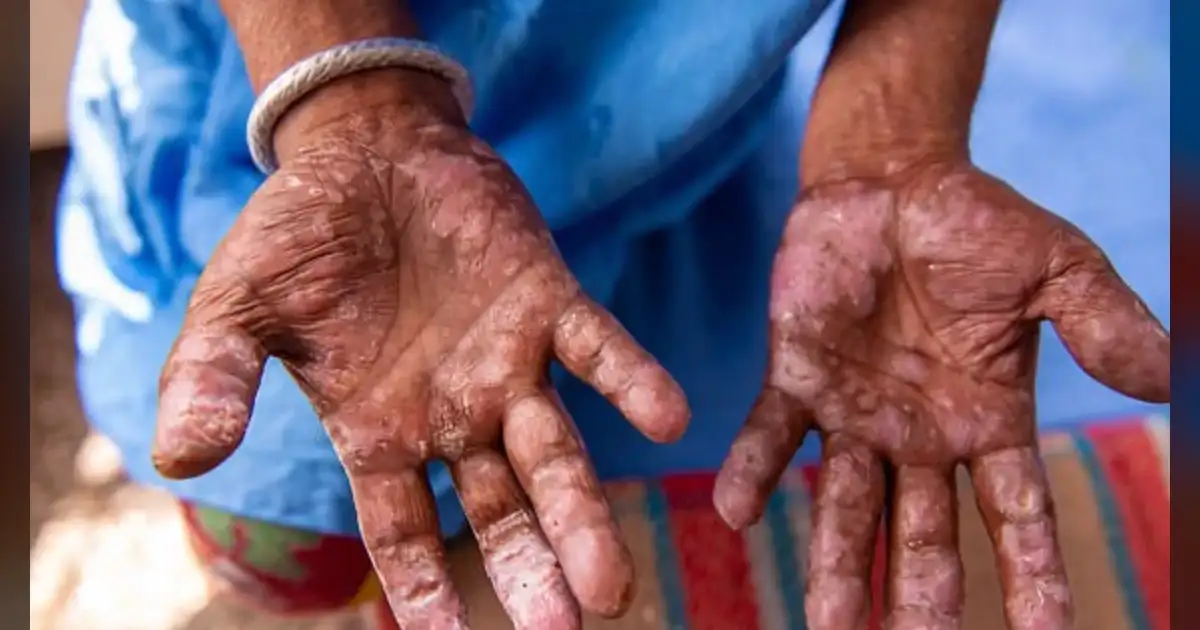 Leprosy Surges in US Due to Climate Change and Travel Risks