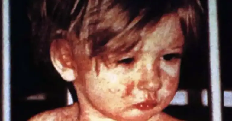 'Measles isn't just a rash; it can kill.