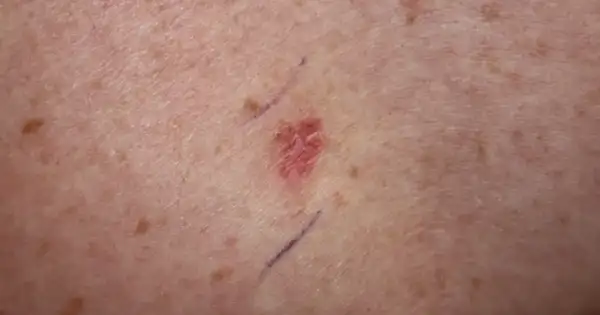 Moderna’s Skin Cancer Vaccine Treats, Doesn’t Prevent Melanoma