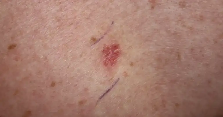 Moderna’s Skin Cancer Vaccine Treats, Doesn’t Prevent Melanoma